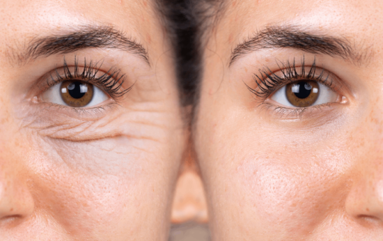 Cum poti scapa de ridurile din jurul ochilor